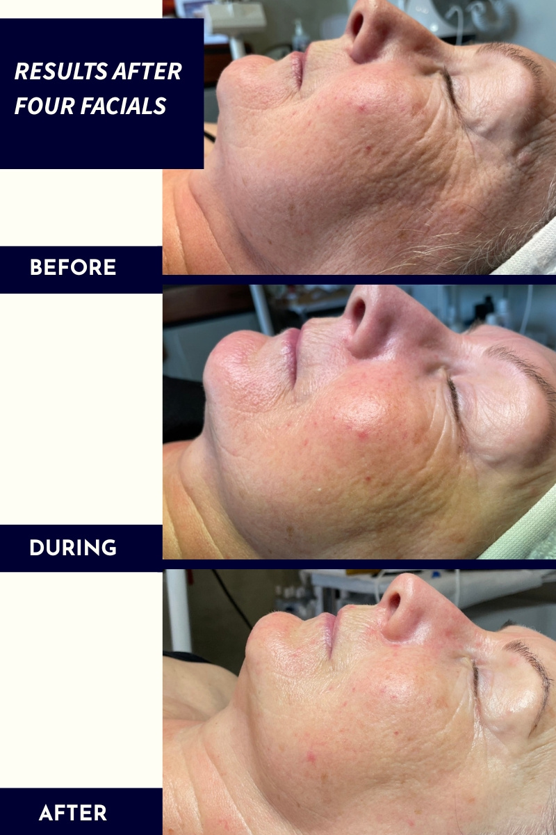 Facial Treatment Results Facial Results